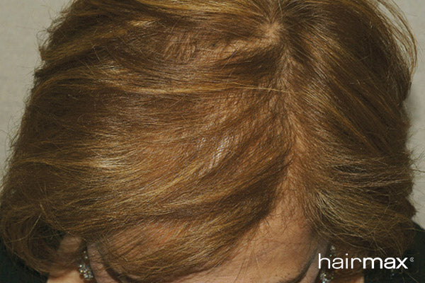Science-Backed Hair Regrowth Technology